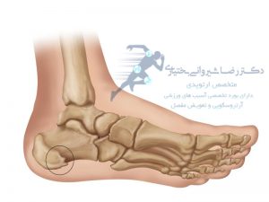 خار پاشنه