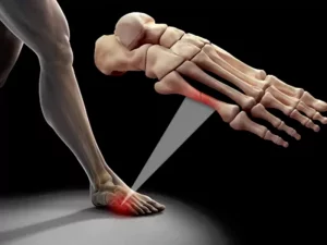 شکستگی استرسی، علل و علائم آن