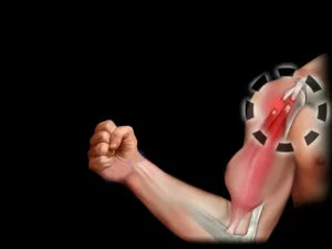 پارگی عضله دوسر بازو یا بدشکلی پوپی