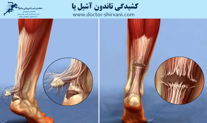 کشیدگی تاندون آشیل پا