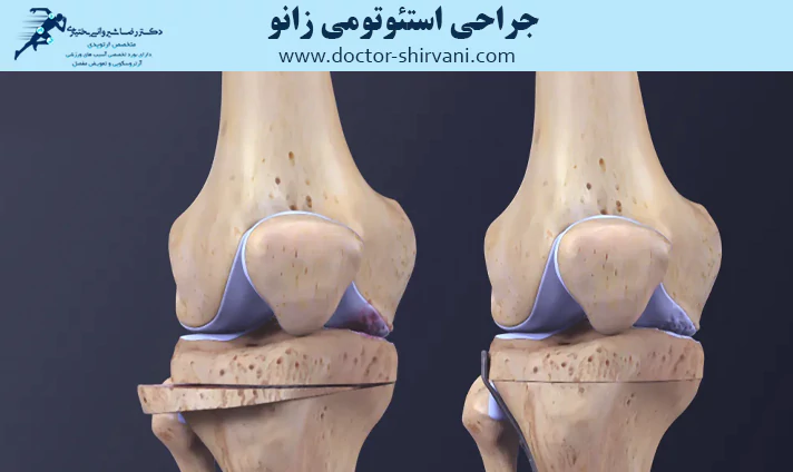جراحی استئوتومی زانو