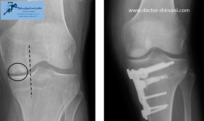 علت انجام جراحی استئوتومی زانو